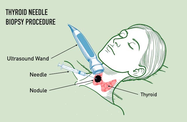 Illustration depicting the thyroid needle biopsy procedure.